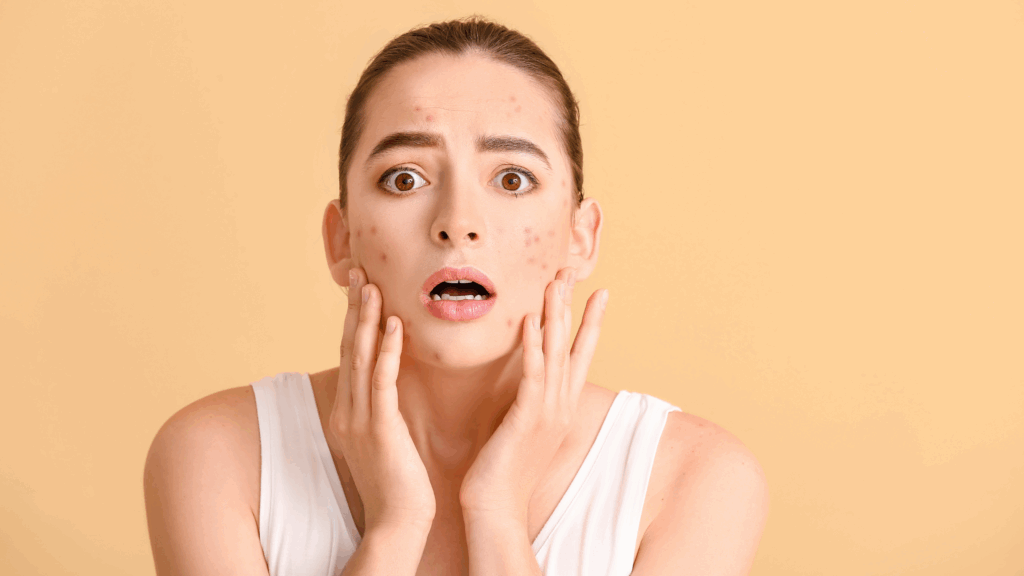 Stressed out woman with acne and acne marks